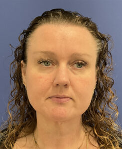 After Image: Patient # 5047