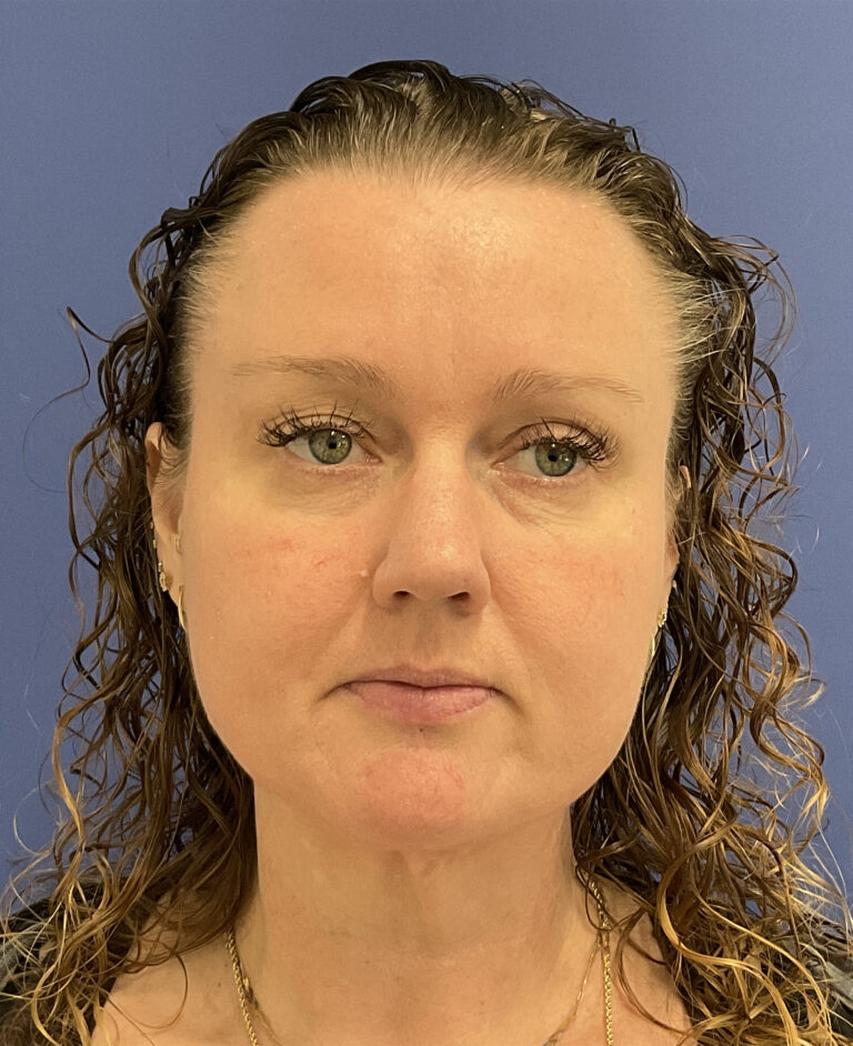 After Image: Patient # 5047 - front