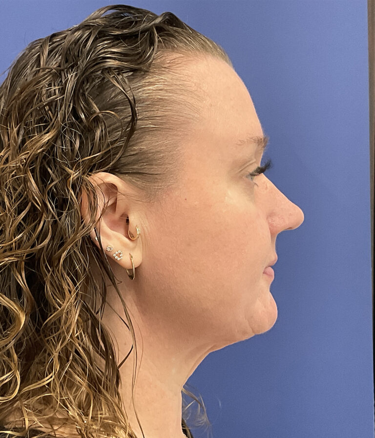 After Image: Patient # 5047 - right-side