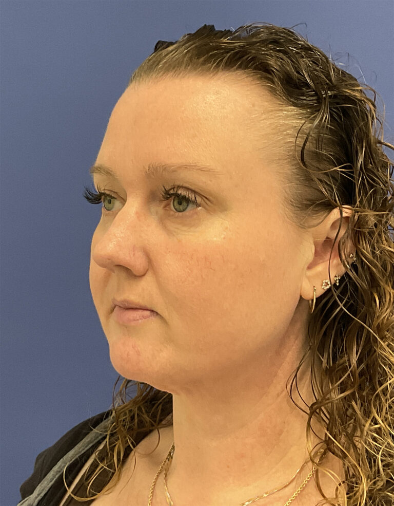 After Image: Patient # 5047 - left-front-oblique