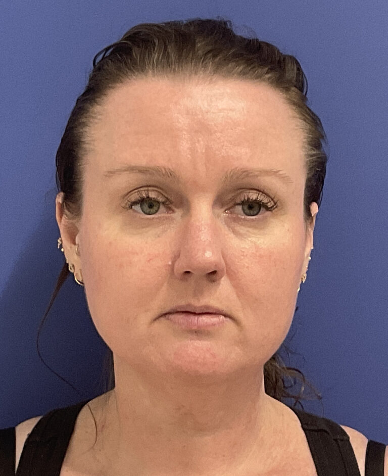 Before Image: Patient # 5047 - front