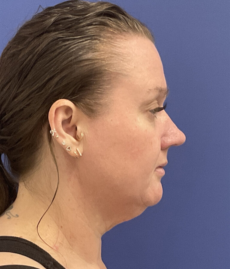 Before Image: Patient # 5047 - right-side