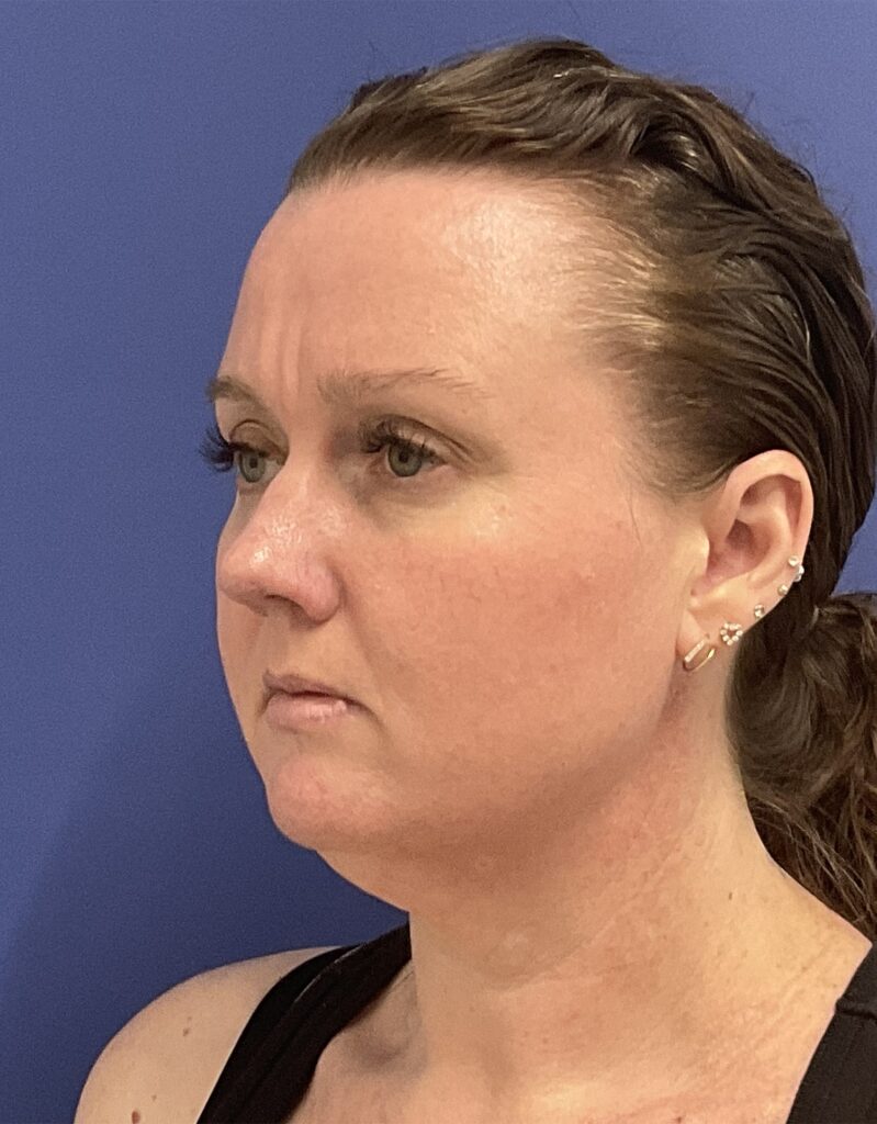 Before Image: Patient # 5047 - left-front-oblique