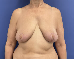 After Image: Patient # 5054