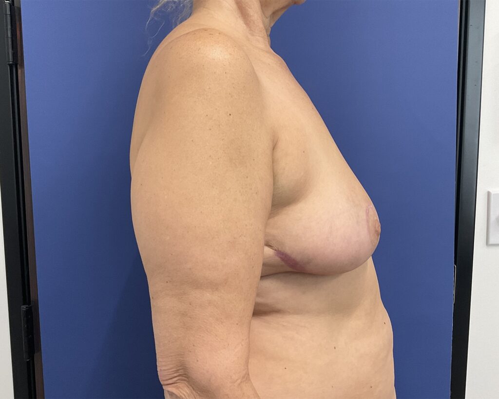 After Image: Patient # 5054 - right-side