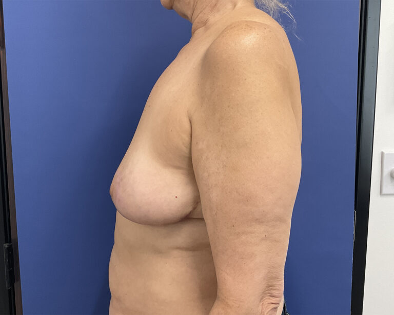 After Image: Patient # 5054 - left-side