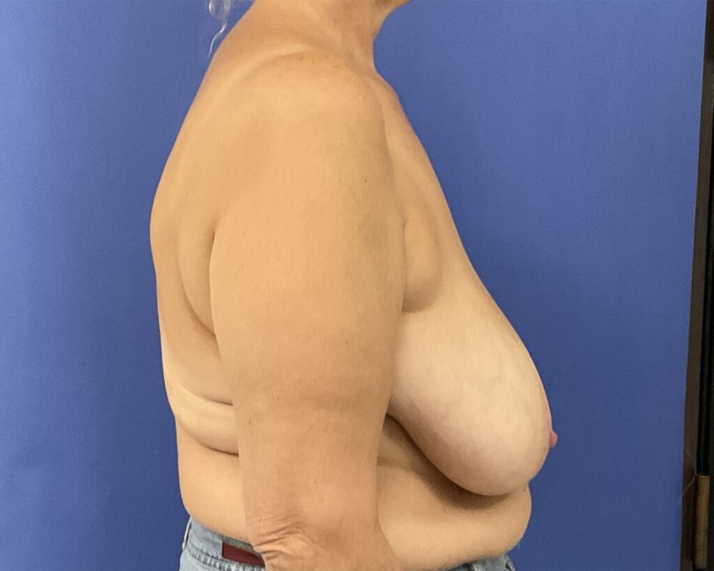 Before Image: Patient # 5054 - right-side