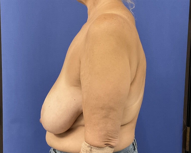 Before Image: Patient # 5054 - left-side