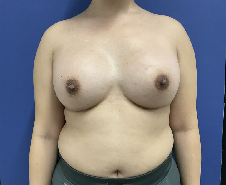 After Image: Patient # 5065 - front