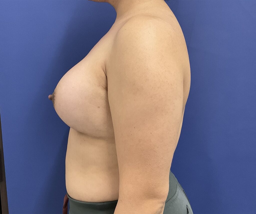 After Image: Patient # 5065 - left-side
