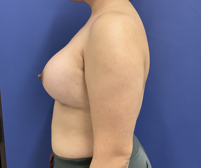 After Image: Patient # 5065 - left-side