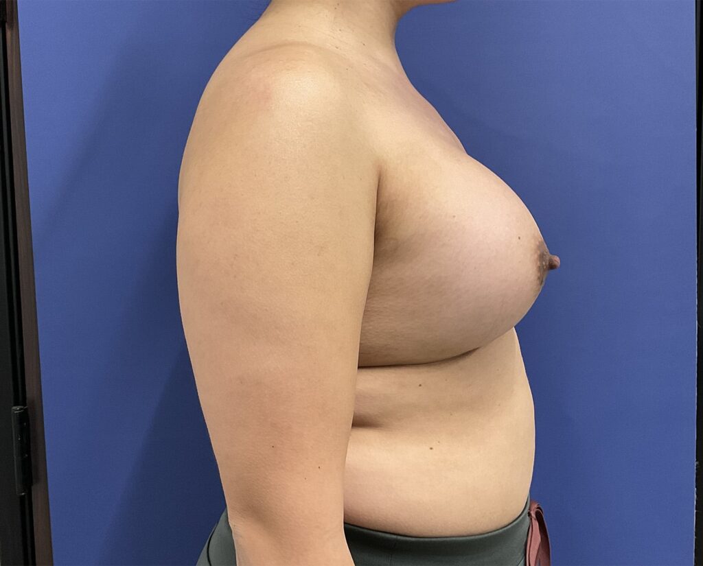 After Image: Patient # 5065 - right-side