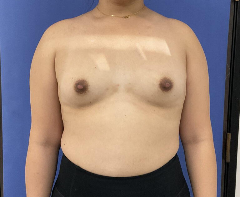 Before Image: Patient # 5065 - front