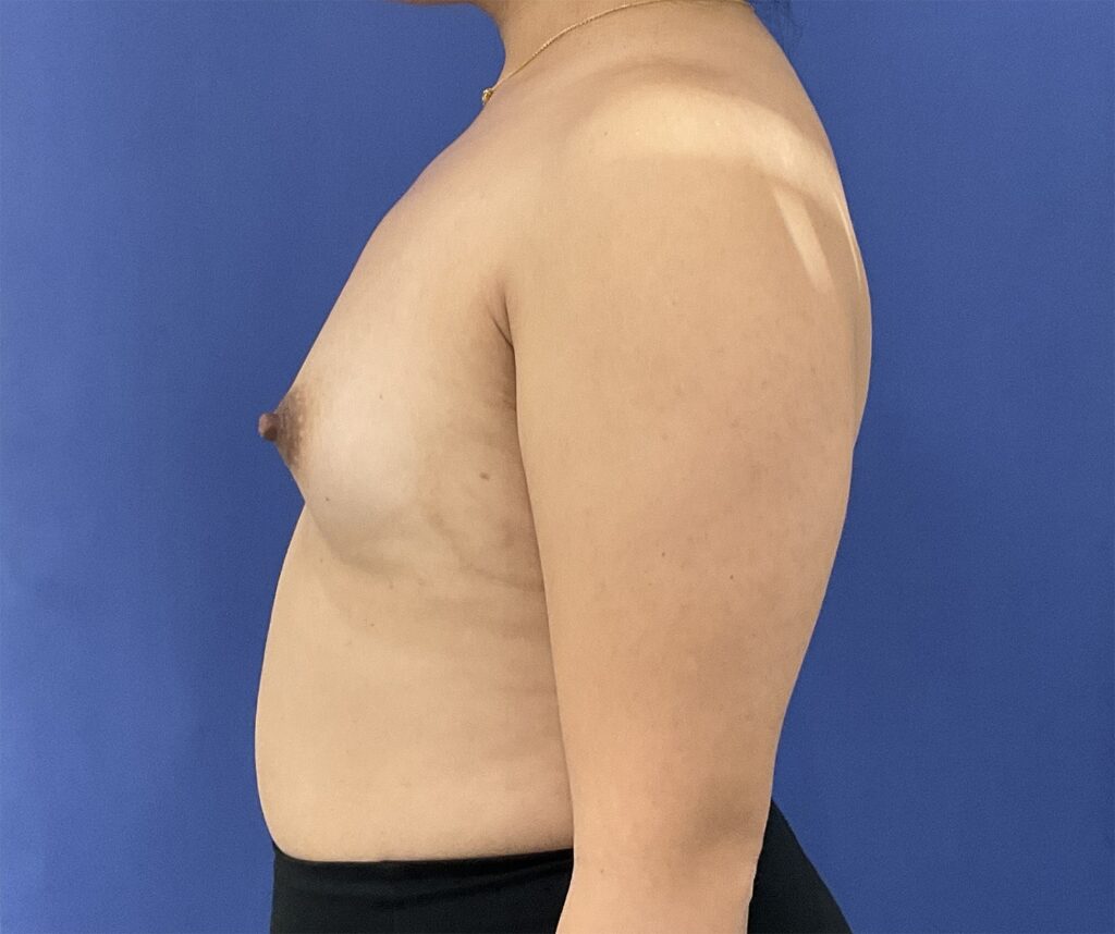 Before Image: Patient # 5065 - left-side