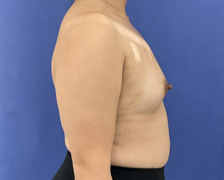 Before Image: Patient # 5065 - right-side