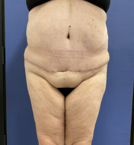 After Image: Patient # 5082