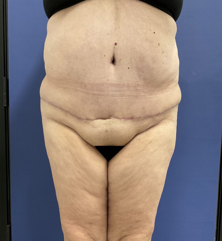 After Image: Patient # 5082 - front
