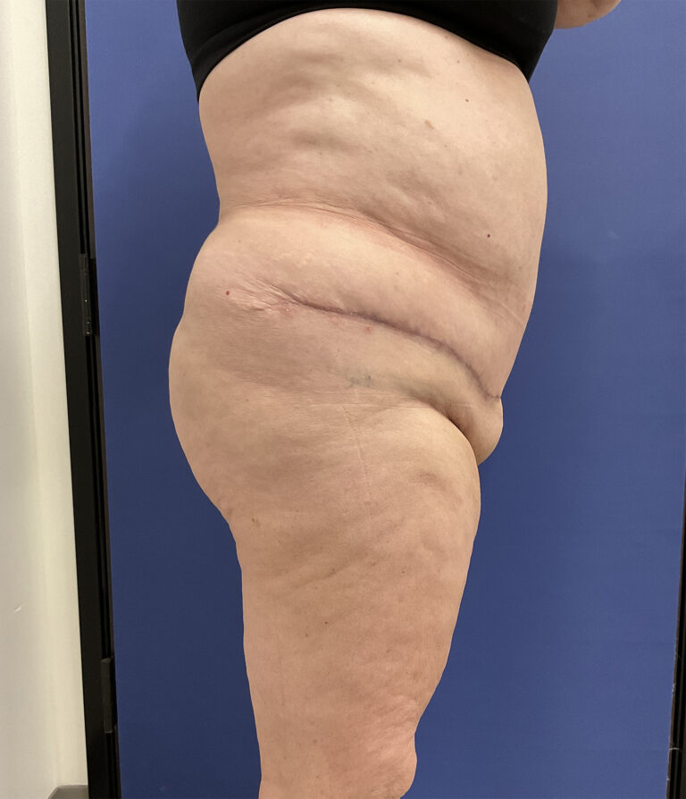 After Image: Patient # 5082 - right-side