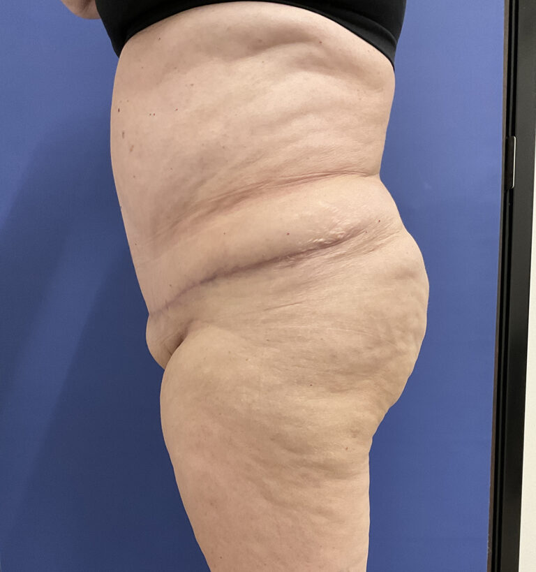 After Image: Patient # 5082 - left-side