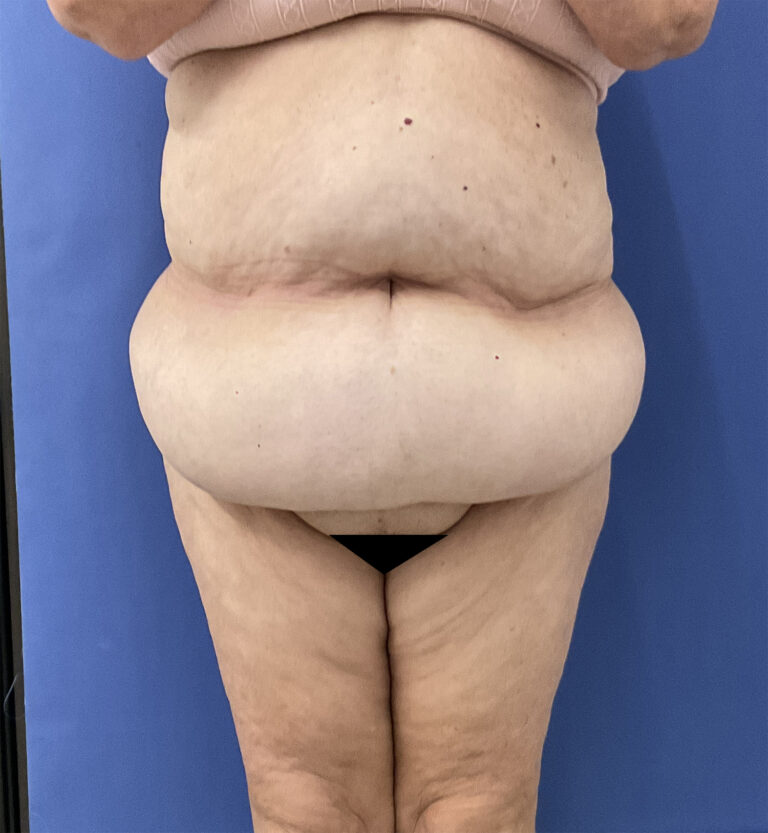 Before Image: Patient # 5082 - front