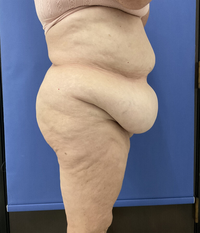 Before Image: Patient # 5082 - right-side