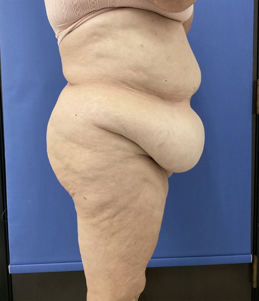 Before Image: Patient # 5082 - right-side