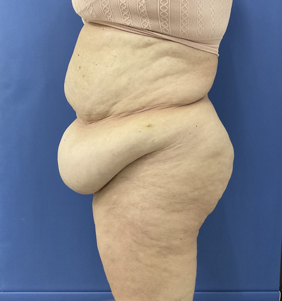 Before Image: Patient # 5082 - left-side