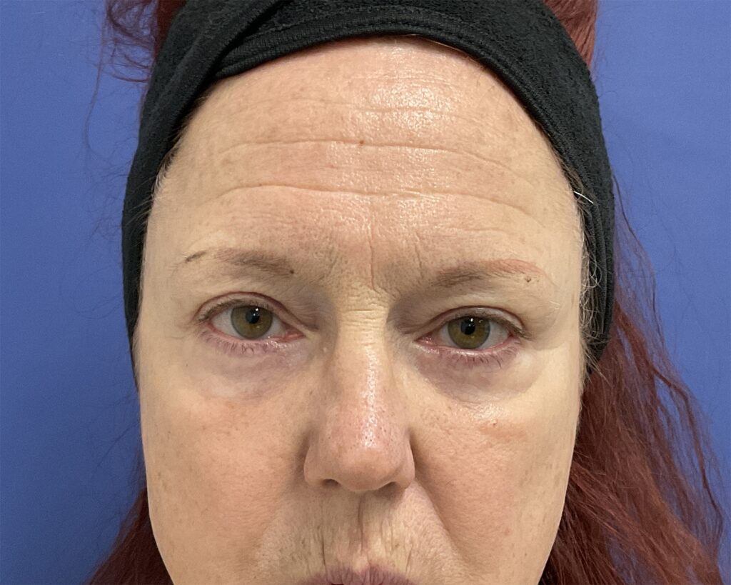 After Image: Patient # 5079 - front