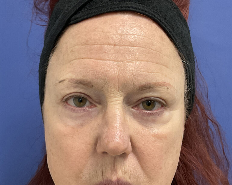 After Image: Patient # 5079 - front