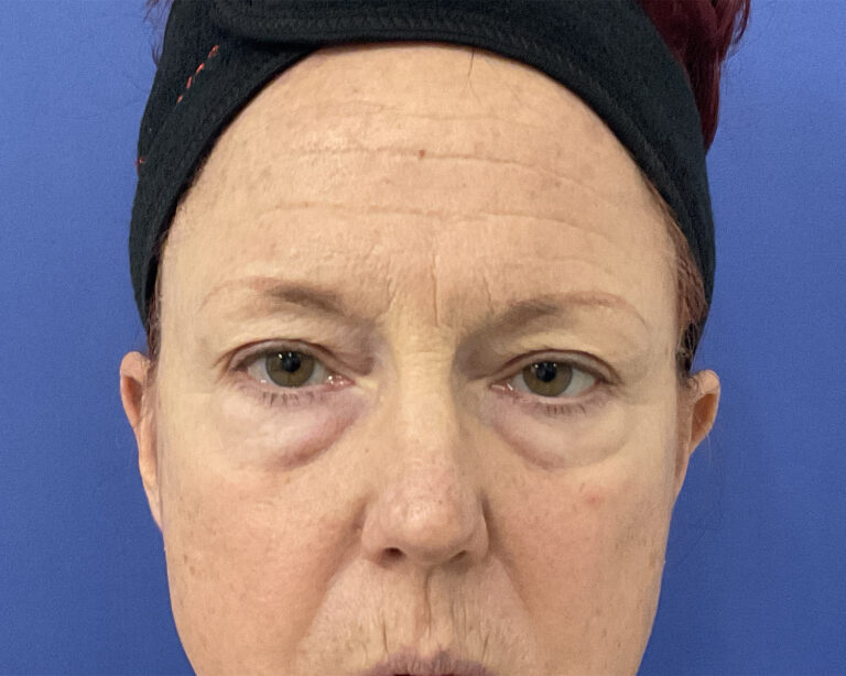 Before Image: Patient # 5079 - front