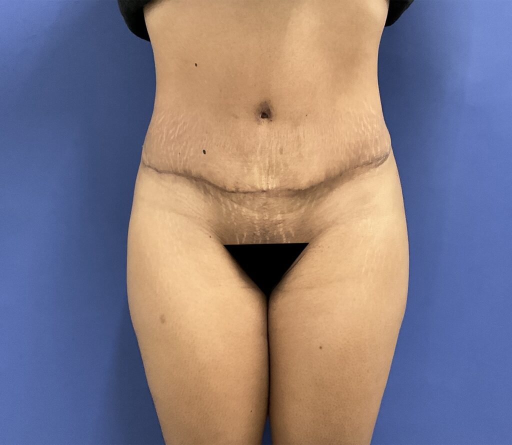 After Image: Patient # 5092 - front