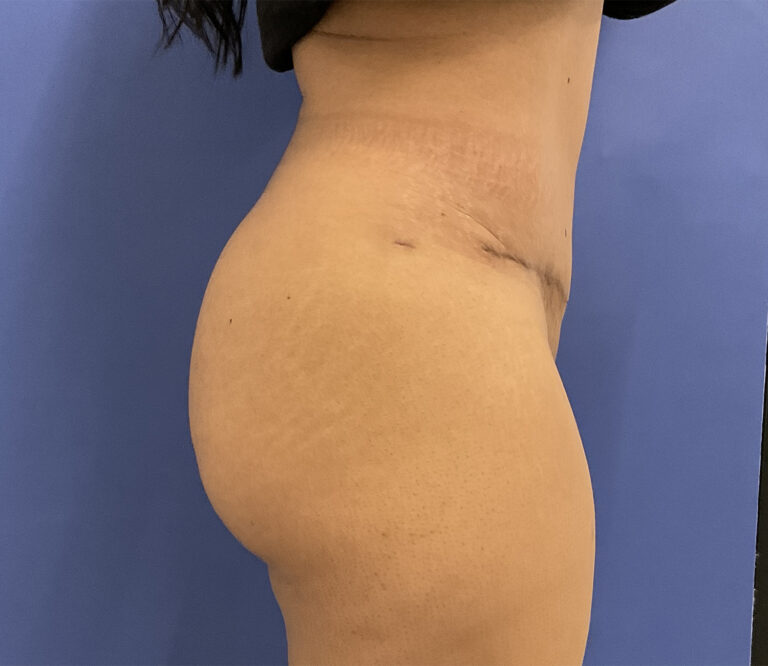 After Image: Patient # 5092 - right-side