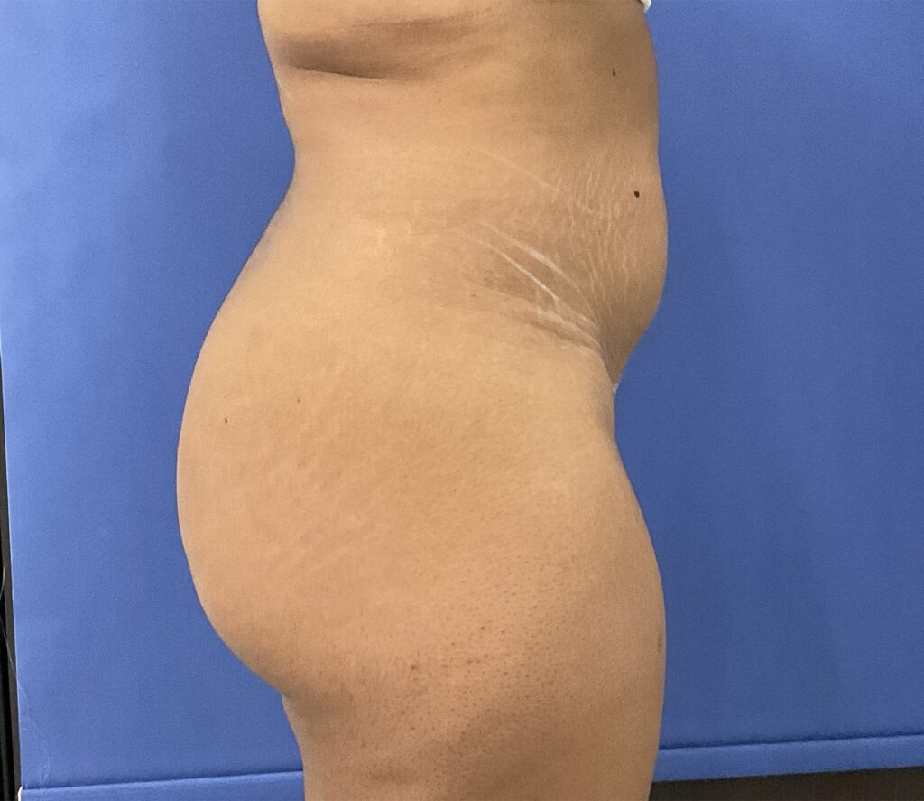 Before Image: Patient # 5092 - right-side