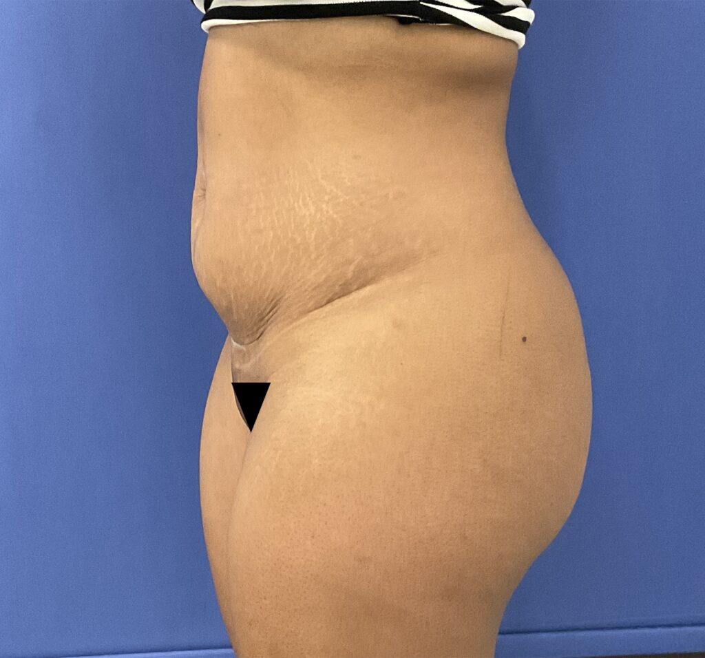 Before Image: Patient # 5092 - left-front-oblique