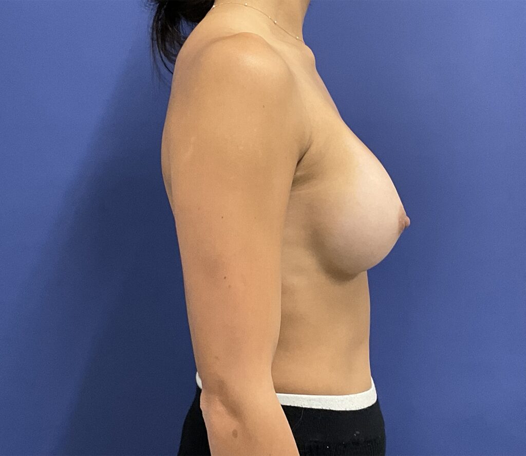 After Image: Patient # 5099 - right-side