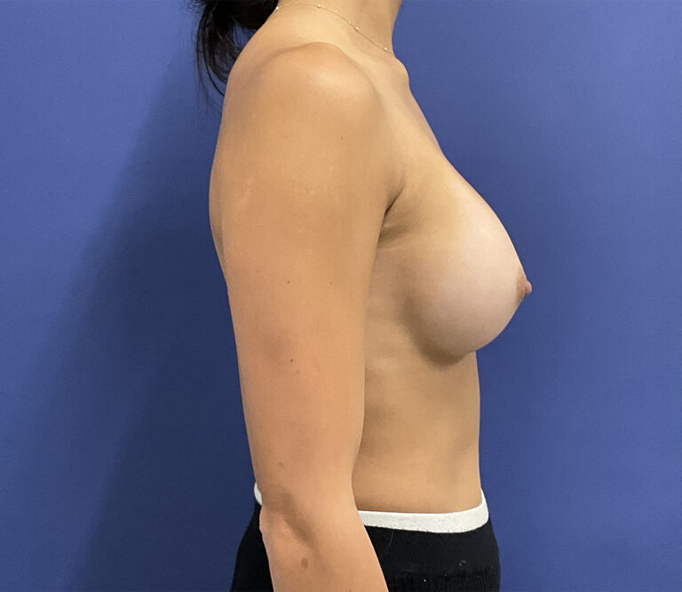 After Image: Patient # 5099 - right-side