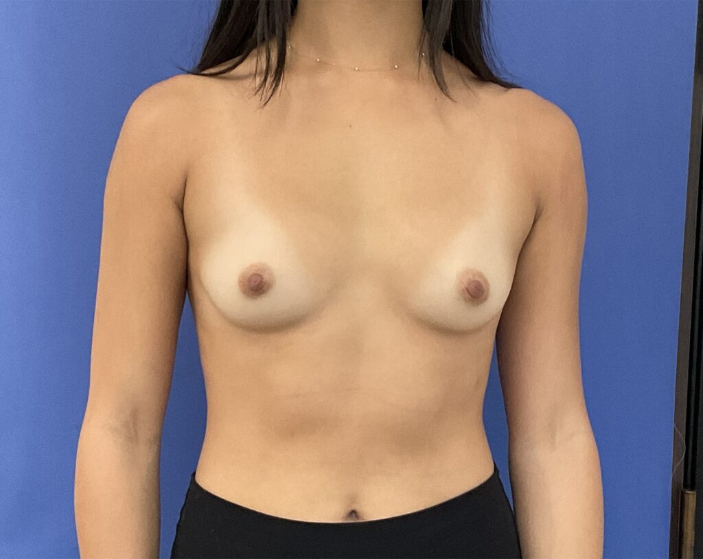 Before Image: Patient # 5099 - front