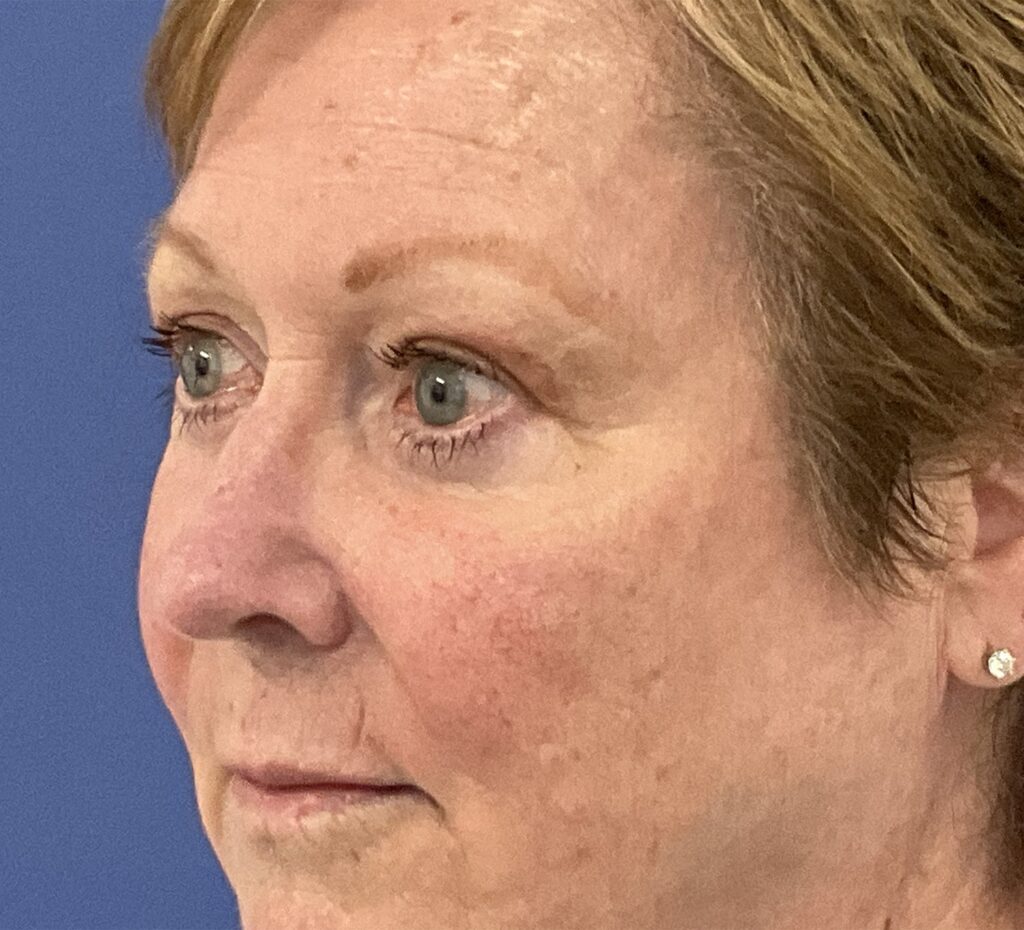 After Image: Patient # 5245 - left-front-oblique