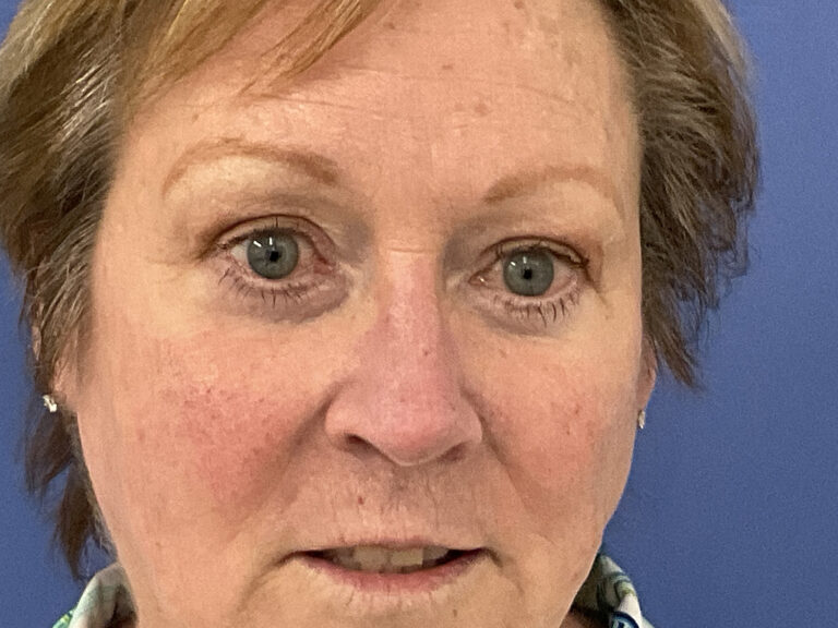 After Image: Patient # 5245 - front