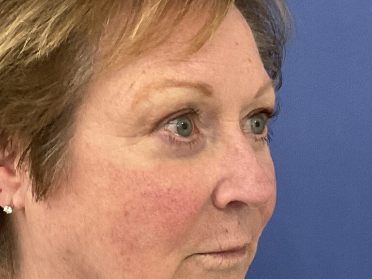 After Image: Patient # 5245 - right-front-oblique