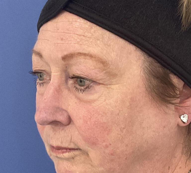 Before Image: Patient # 5245 - left-front-oblique