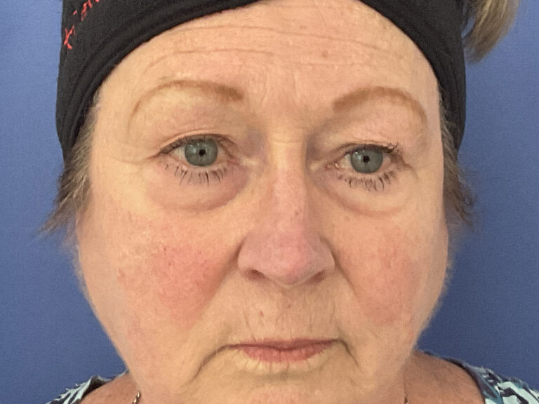 Before Image: Patient # 5245 - front
