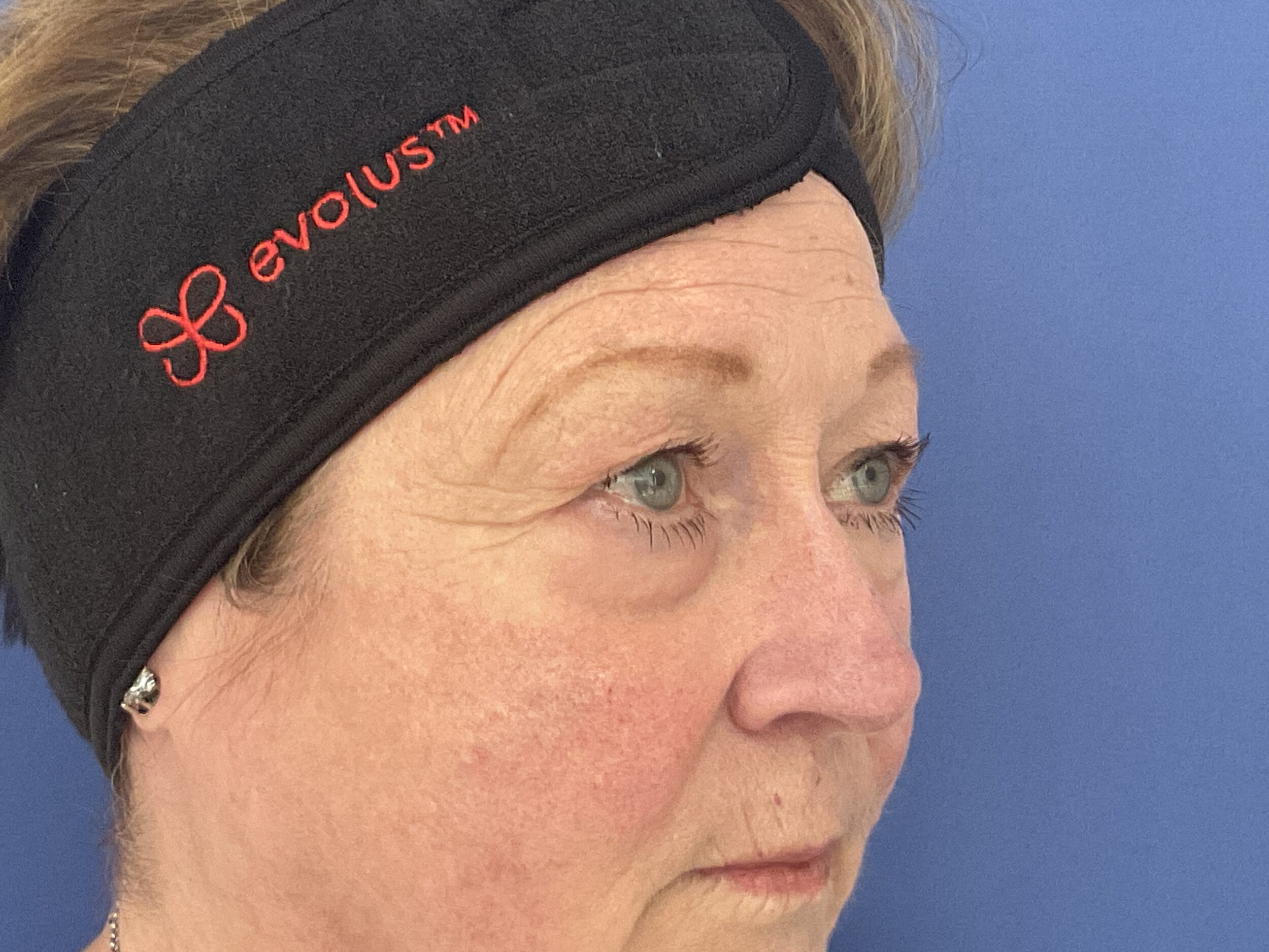 Before Image: Patient # 5245 - right-front-oblique