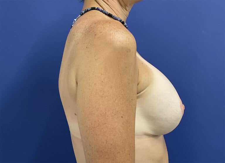 After Image: Patient # 5253 - right-side