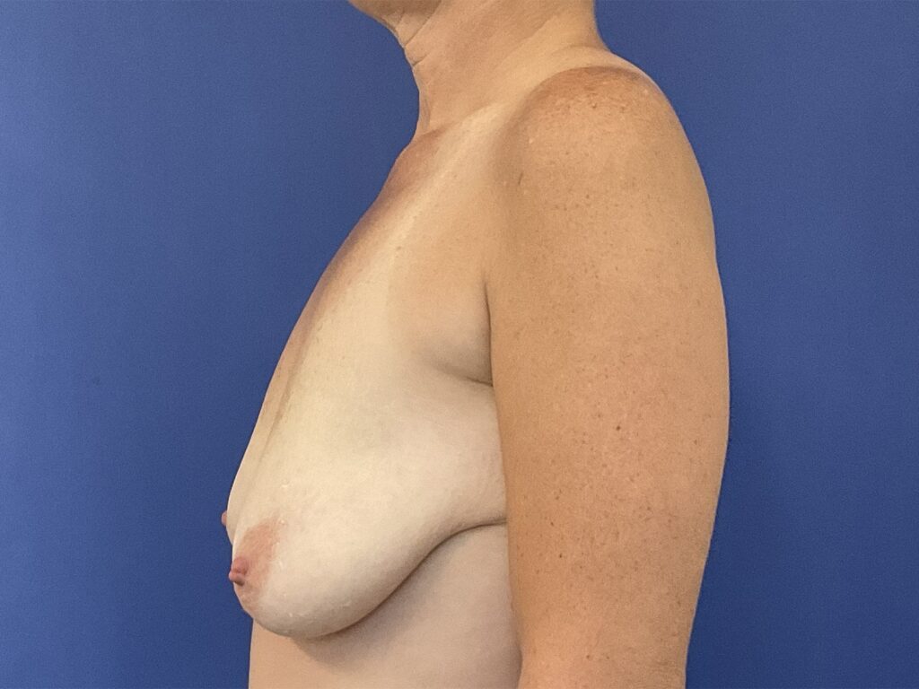 Before Image: Patient # 5253 - left-side