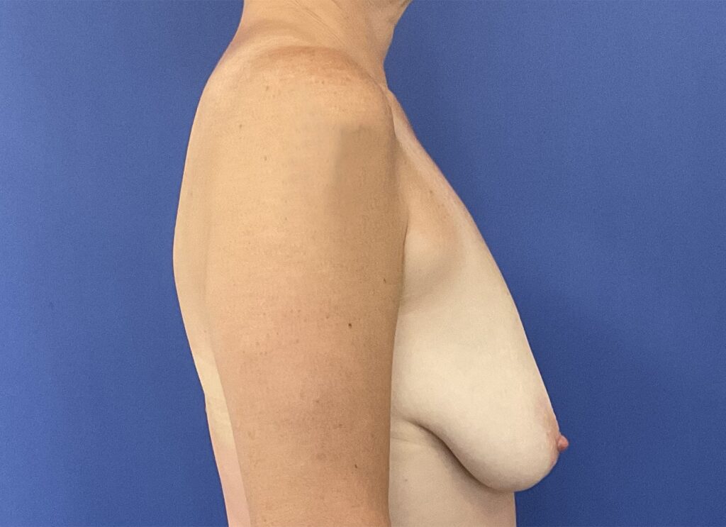 Before Image: Patient # 5253 - right-side