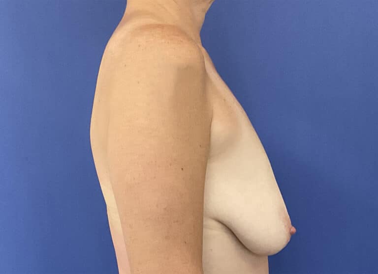 Before Image: Patient # 5253 - right-side