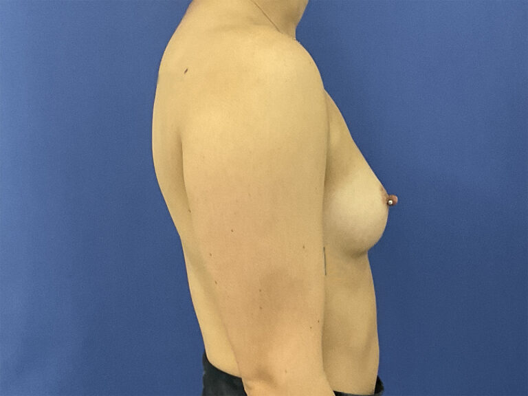 Before Image: Patient # 5290 - right-side