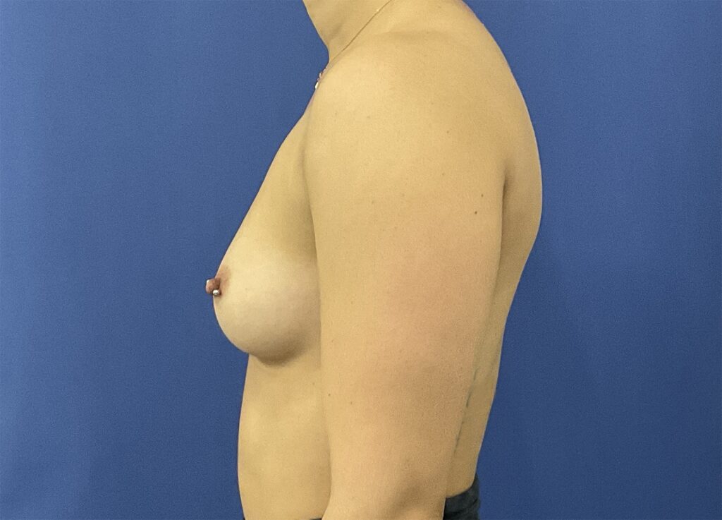 Before Image: Patient # 5290 - left-side