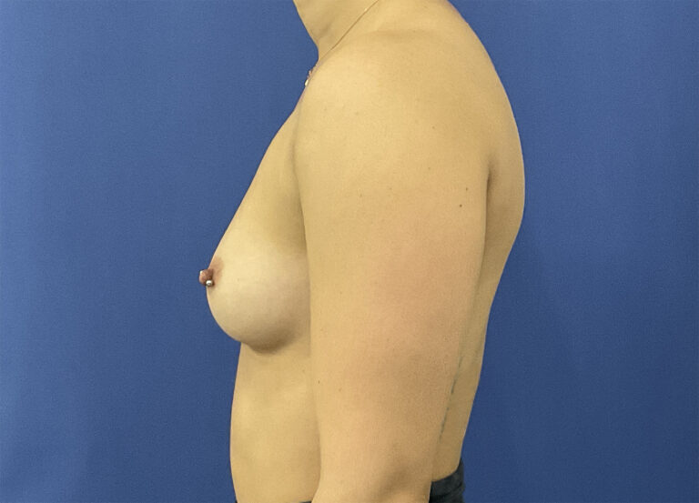 Before Image: Patient # 5290 - left-side